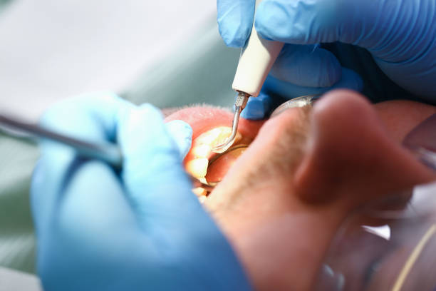 Best Emergency Tooth Extraction in South Monroe, MI